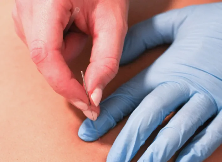 Dry needling behandeld je triggerpoints. Kleine verhardingen in een spier die pijn uitstralen