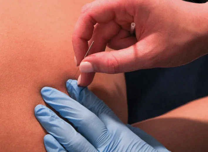 Behandeling tegen myofasciale pijn