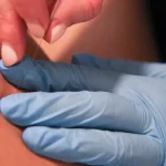 Dry Needling - Krommenie