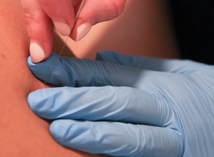 Dry Needling - Krommenie